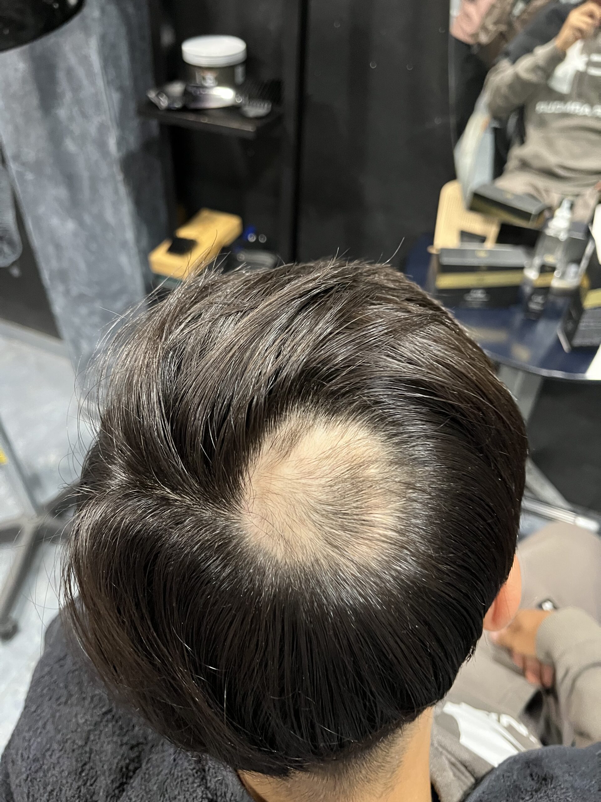 Antes del tratamiento de alopecia areata