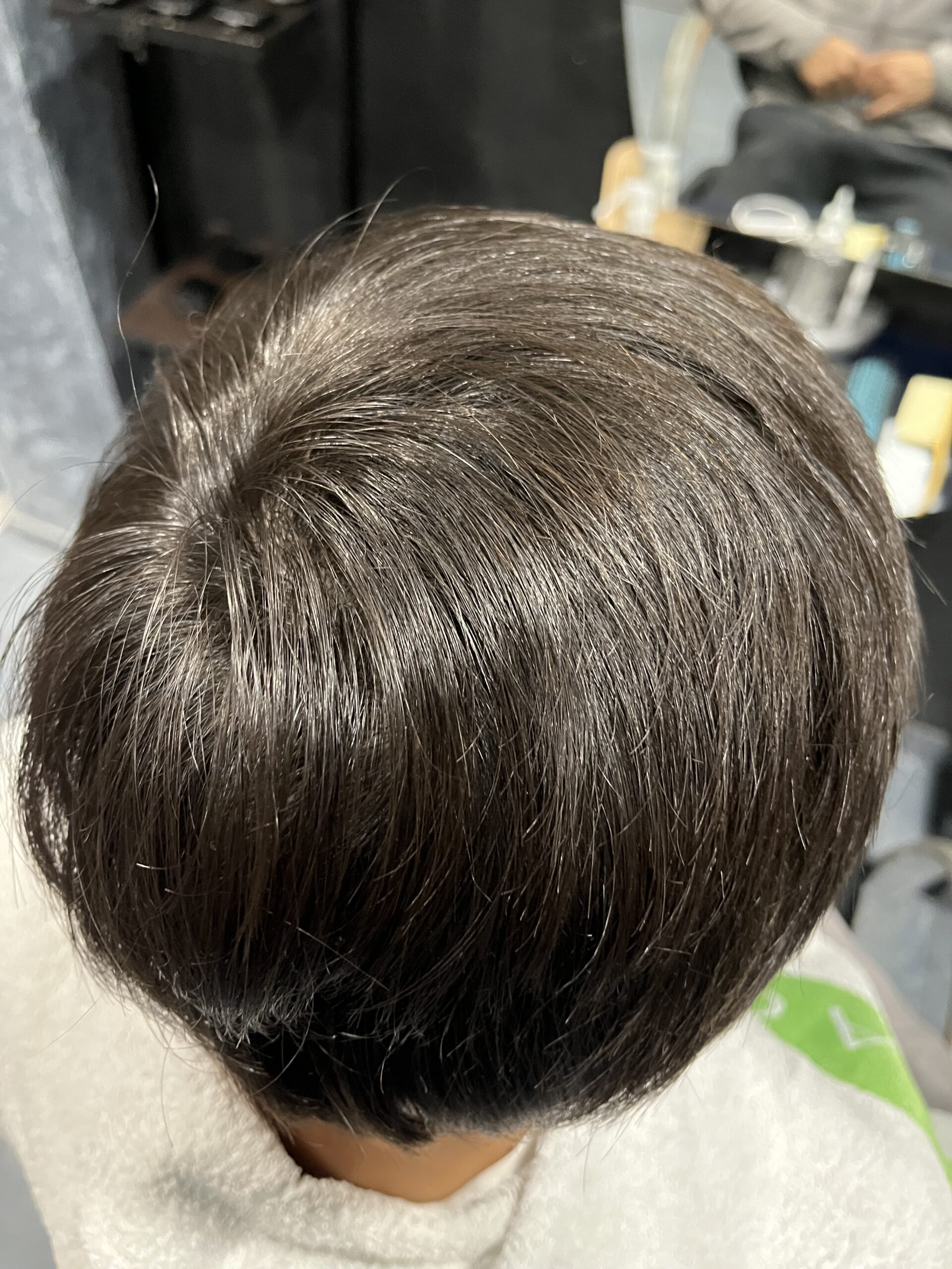 Tratamiento alopecia areata